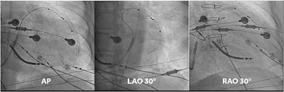 Acute Hemodynamic Effects of Simultaneous and Sequential Multi-Point Pacing in Heart Failure Patients With an Expected Higher Rate of Sub-response to Cardiac Resynchronization Therapy: Results of Multicenter SYNSEQ Study